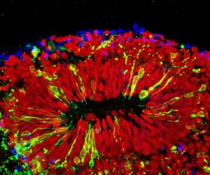 Lab-Grown Brain Clusters Offer New Window into Neurological Disease